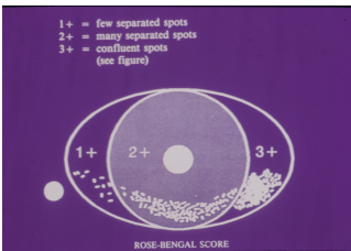 rose bengal stain.PNG